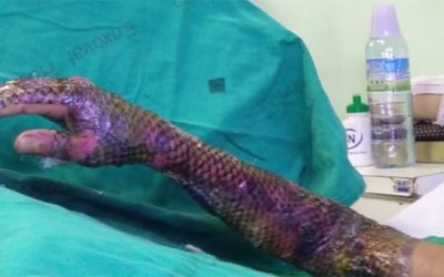 Fish Skin for Burn Victims