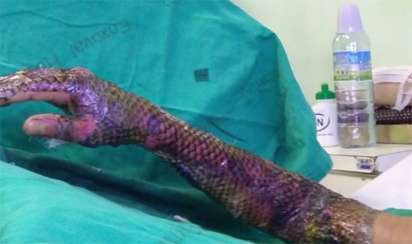 Fish Skin for Burn Victims